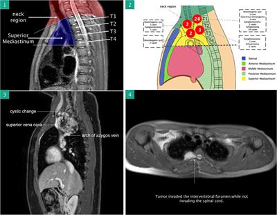 Initial experience with robotic-assisted thoracic surgery for superior mediastinal masses